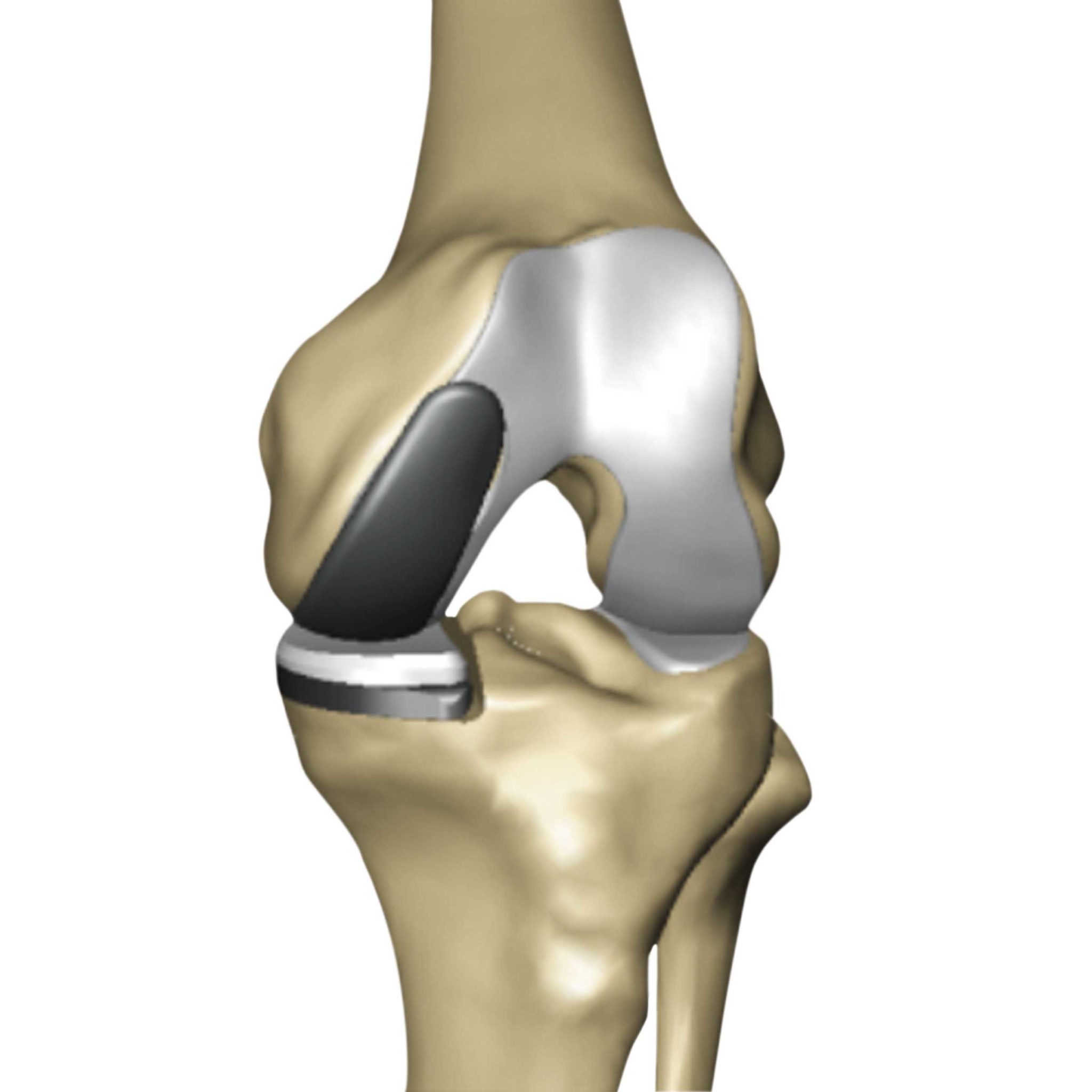 what is a partial knee replacement